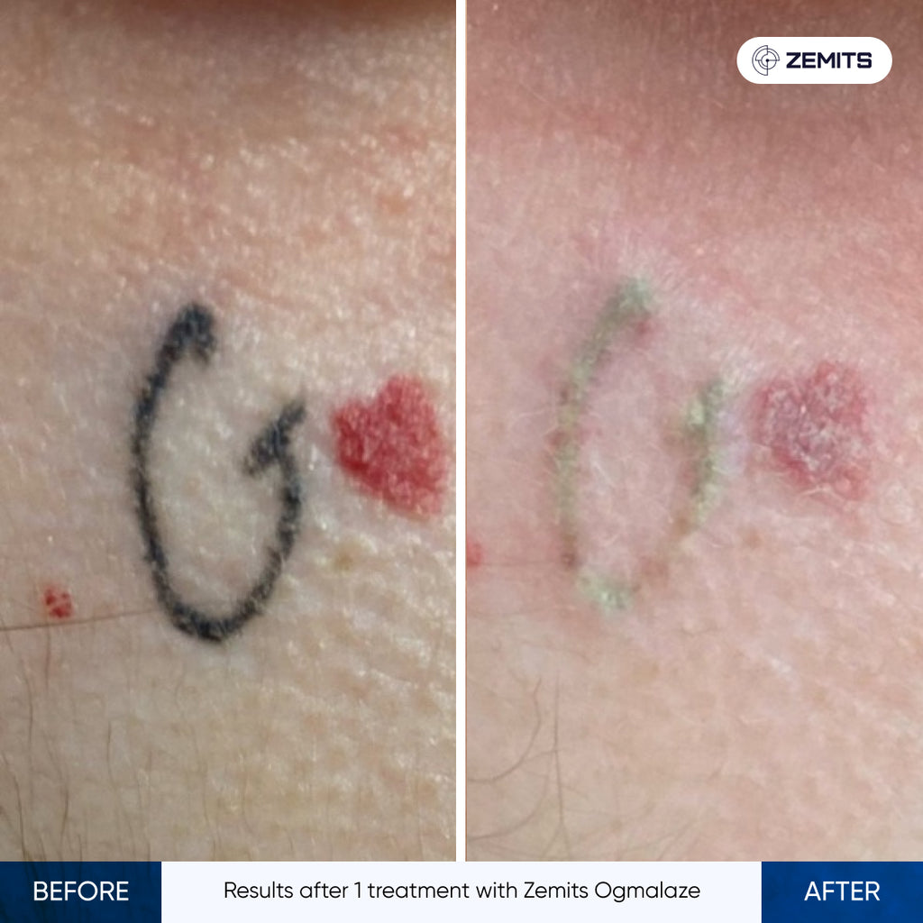 Before and after tattoo removal results Zemits OgmaLaze