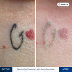 Before and after tattoo removal results Zemits OgmaLaze