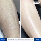 Before and after hair removal results Zemits Quidion Lite