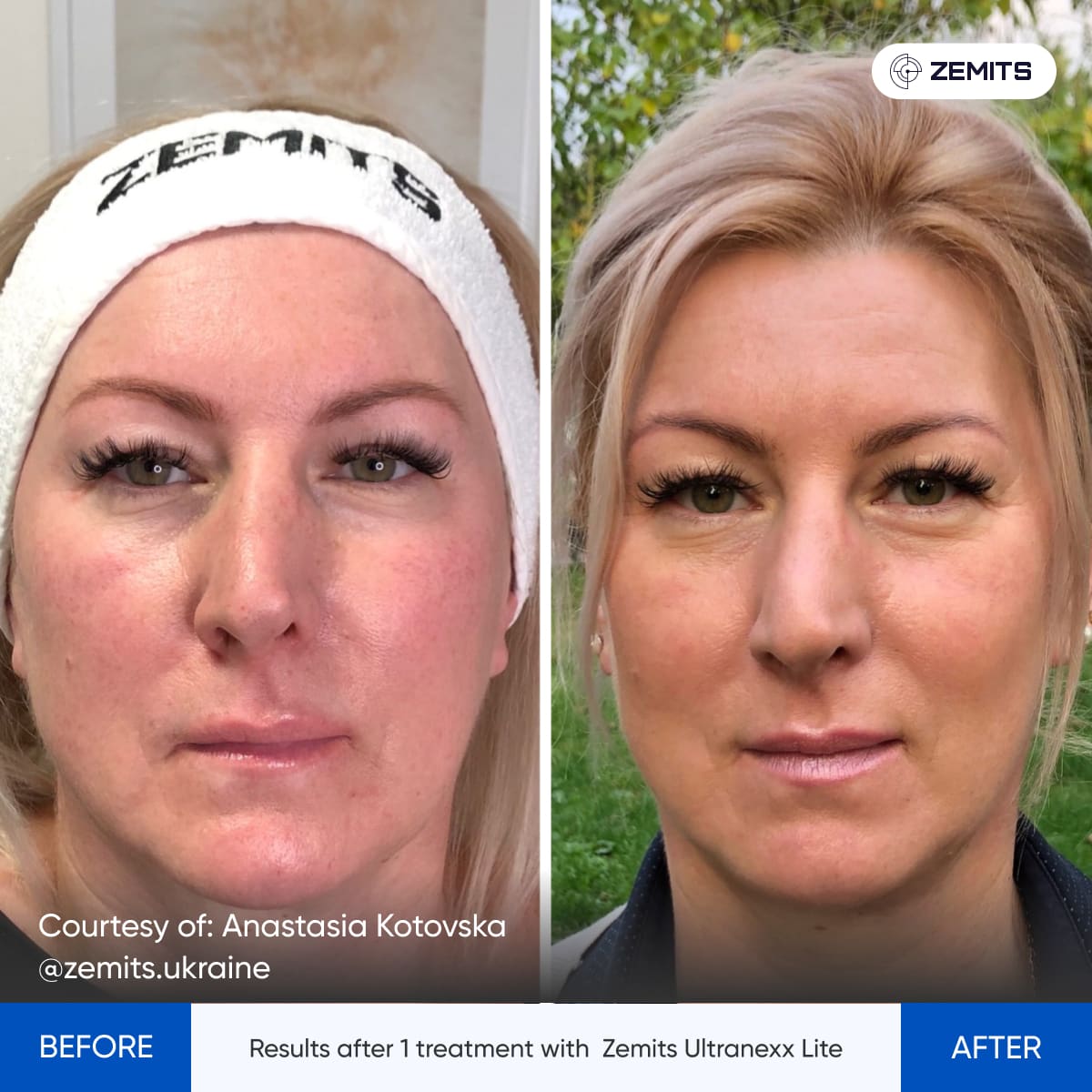 Before After Slide 1