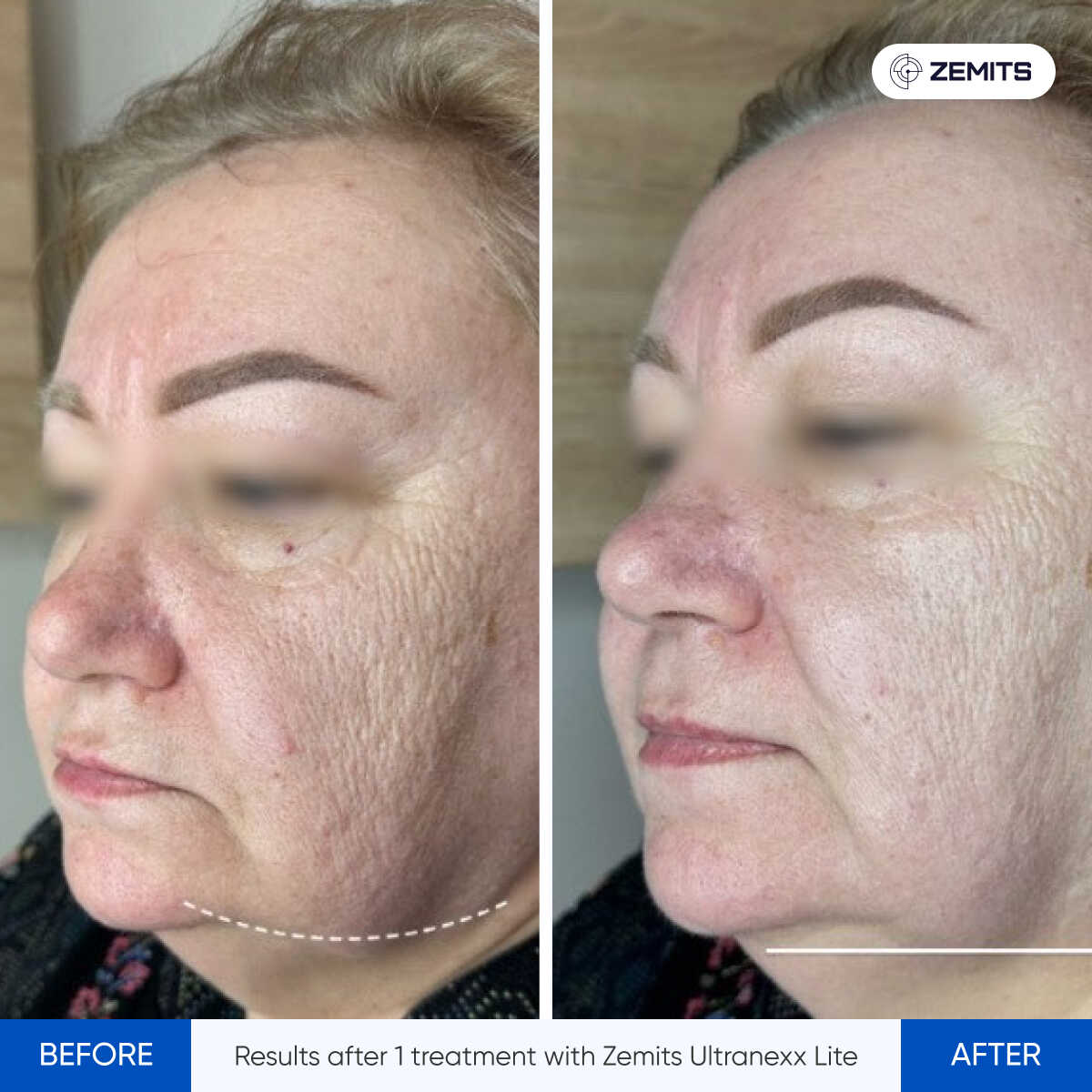 Before After Slide 5